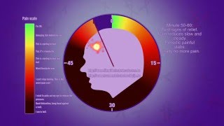 Cluster headache attack [upl. by Duleba909]