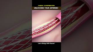 unlocking Your Arteries Cardiac Catheterization cardiology [upl. by Ecirtap]