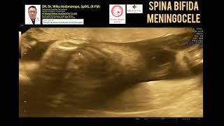 Spina Bifida Meningocele [upl. by Kadner309]