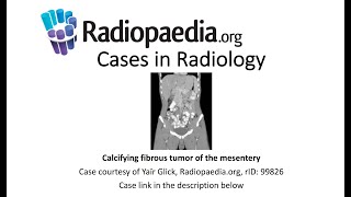 Calcifying fibrous tumor of the mesentery Radiopaediaorg Cases in Radiology [upl. by Janelle]