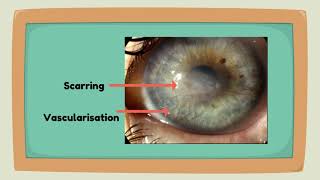 Educational video to support diagnosis of Herpes Simplex Keratitis [upl. by Atiekal]