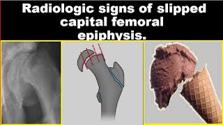 Radiologic signs of Slipped Capital Femoral Epiphysis [upl. by Tella]