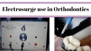 Electrosurge use in Orthodontics [upl. by My]