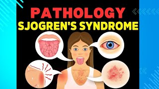 24 Sjogren Syndrome and Scleroderma [upl. by Suolekcin576]