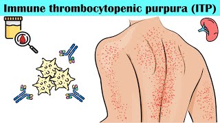 Immune Thrombocytopenic Purpura ITP  Causes Pathogenesis Signs amp Symptoms Diagnosis Treatment [upl. by Grannia441]