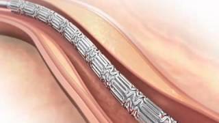 YouTube Coronary Stent Animation [upl. by Oyr]