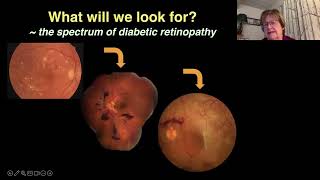 Lecture Screening amp Referral for Diabetic Retinopathy [upl. by Gillian]