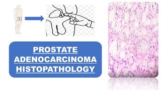 Prostate Adenocarcinoma Histopathology [upl. by Hailey]