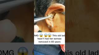 Ear Wax Removal 25 [upl. by Ydna]