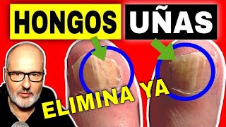 HONGOS EN LAS UÑAS CÓMO ELIMINAR Y PREVENIR LA ONICOMICOSIS EN PIES Y MANOS [upl. by Alledi]