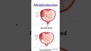 Abruptio placentae  viralshorts abruptioplacentae placenta [upl. by Ecinreb12]