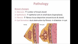 Fibroadenosis [upl. by Andrade]