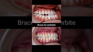 Underbite braces evolution braces orthodontist dentist bracesoff [upl. by Jollenta]