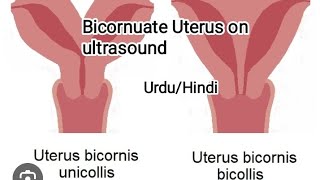 Pelvic UltrasoundBicornuate uterusseptate unterus [upl. by Orteip]