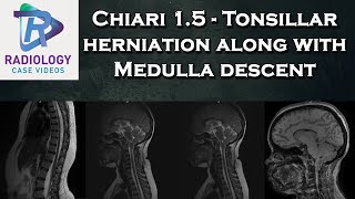 Chiari 15  Tonsillar herniation along with Medulla descent [upl. by Nonnaehr]