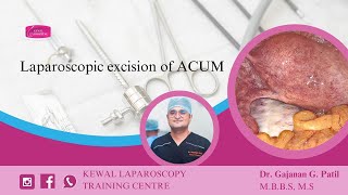 Laparoscopic excision of ACUM Kewal Hospital  Laparoscopy Training [upl. by Eirena]