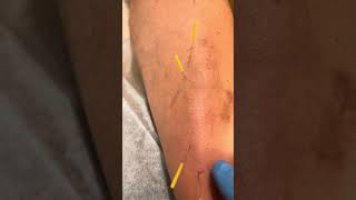 ￼ Achilles tendinitis and trigger points released with dry needling [upl. by Rondon]