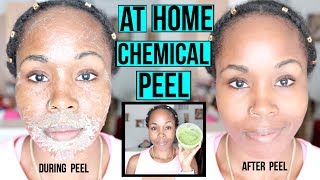 HOW TO Make a NATURAL Chemical Peel AT HOME  ERASE ACNE WRINKLES amp DARK SPOTS [upl. by Attehcram197]