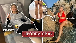 Meine LETZTE Lipödem OP 🥹 Bis 7 Monate danach 👀 OP 4  DominoKati [upl. by Aneehsat]