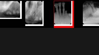 Rampant caries and root tips on PA and Pano [upl. by Aneleiram]