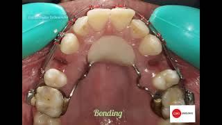 orthodontic treatment with only upper 1st premolar extraction upper 4 4 extracted [upl. by Bennion]