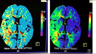 Video 1 of 3 How to interpret a Brain CT Perfusion Scan for acute stroke [upl. by Hbahsur31]