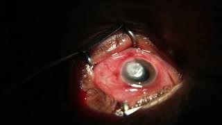 Fungal keratitis intrastromal antifungal therapy [upl. by Yrojram]