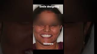 Get rid of fluorosis and gaps Improve your smile with veneers [upl. by Aihseit666]