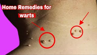 How to remove warts home remedies [upl. by Oemac]