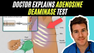 Doctor explains Adenosine Deaminase test  Tuberculosis TB [upl. by Martynne]