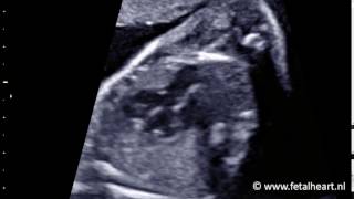 Fetal heart Academy  Tetralogy of Fallot 1 LVOT [upl. by Jakob]