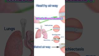 What Is Bronchiectasis bronchiectasis pulmonary lungs [upl. by Eehsar82]