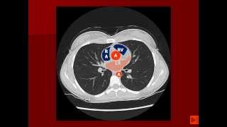 Normal Chest CT with labels [upl. by Einomrah]