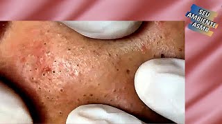 Retirando Cravos Pretos no Rosto  Acne Treatment  Vídeos Satisfatórios 053 [upl. by Nnaeirb973]