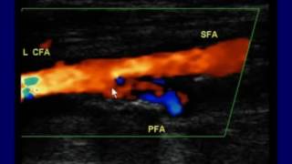 How to DoRead and Interpret the Arterial Duplex Exam [upl. by Alurd]