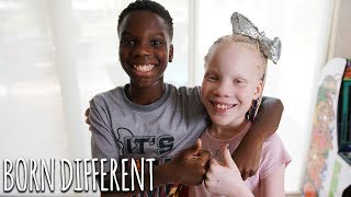 My Twin Sister Has Albinism  BORN DIFFERENT [upl. by Brodench]