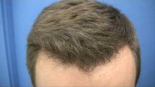 Hair Transplant  1489 Grafts  Dr Wong [upl. by Dorsman]