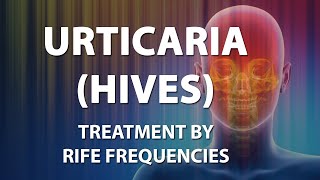 Urticaria Hives  RIFE Frequencies Treatment  Energy amp Quantum Medicine with Bioresonance [upl. by Amaris]