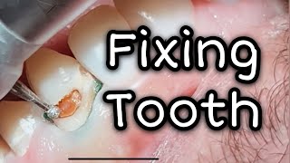 How to fix cavities in front teeth  Dental ASMR [upl. by Nnylhtak743]