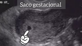 6 SEMANAS DE EMBARAZO FUI A QUE HICIERAN UN ULTRASONIDO VAGINAL  SÓLO VIMOS EL SACO GESTACIONAL [upl. by Eskil798]