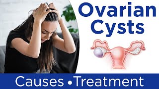 ❇️ What are Ovarian Cysts  💹Ovarian Cysts Symptoms Causes And Treatment in Hindi [upl. by Stephanie]