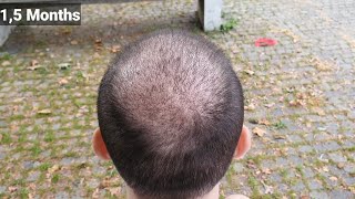 FUE Hair Transplant Timeline I Day 1 to Day 365 I Before amp After [upl. by Ahsayn]