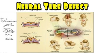 Neural Tube Defect Embriologi Patofisiologi Spina Bifida Encephalocele Anencephaly Pencegahan [upl. by Nylirej886]