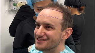 How to decide Hair transplant hairline height [upl. by Enaerb]