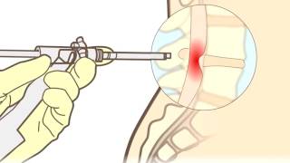 Hernia discal ¿qué es ¿Cómo se opera  Neurocirugía Torres [upl. by Baker855]