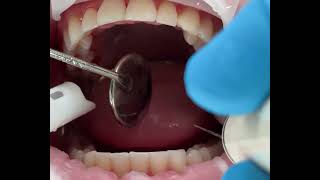 ASMR  Dental scaling [upl. by Hanikas]