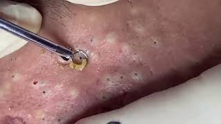 blackheads New this week 2023 [upl. by Nataline]