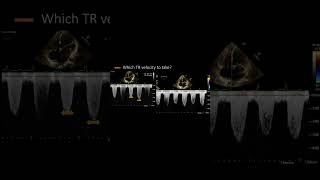 Respiratory Variability of Tricuspid Regurgitation [upl. by Odnalref]