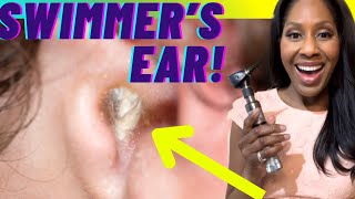 SWIMMER’S EAR Otitis Externa Treatments Causes amp Prevention A Doctor Explains [upl. by Tad]