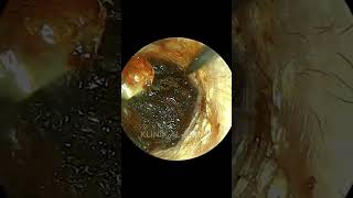 Agonizing Painful Impacted Earwax🤯 [upl. by Redvers]